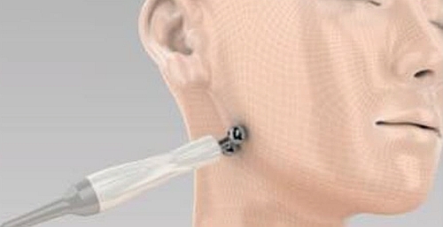 Feszesítés: Y-alakú lifting mikroárammal